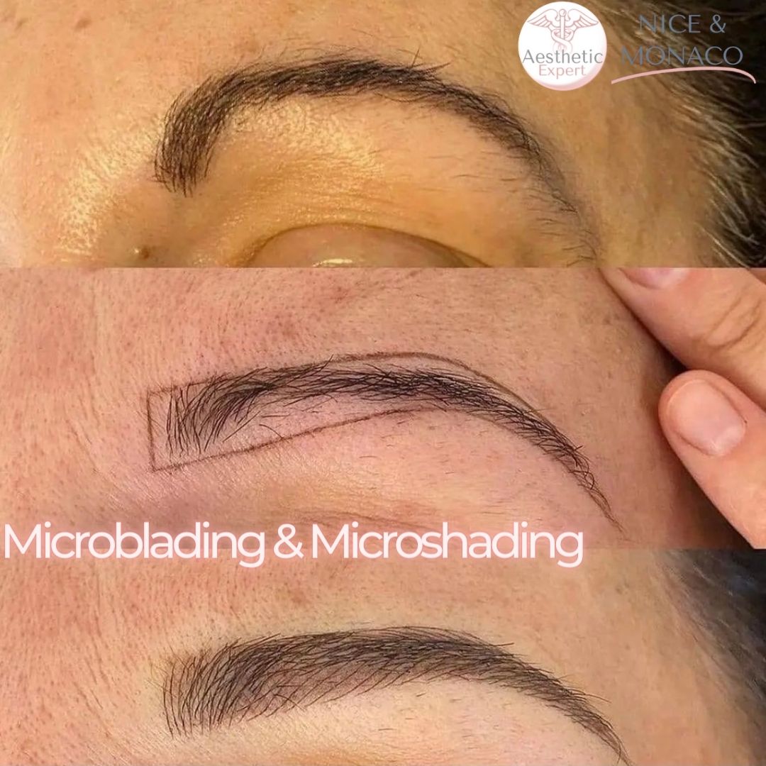 Microbladingtmicroshading