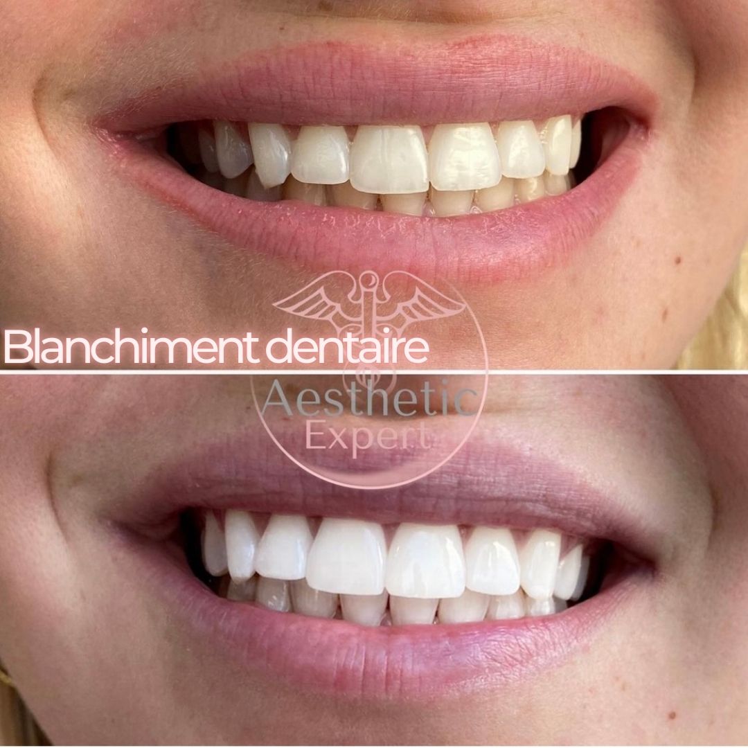 blanchiment-dentaire-nice