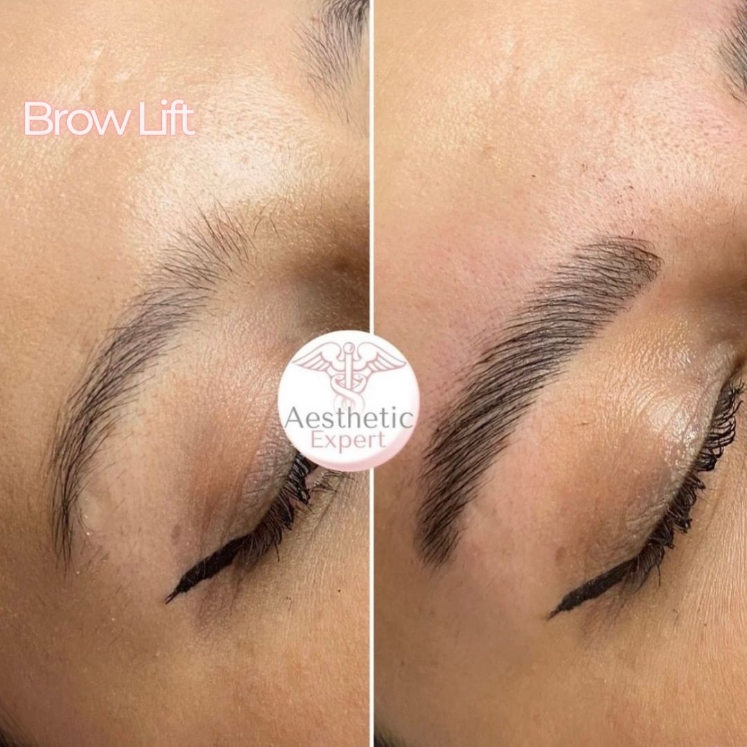browlift-nice