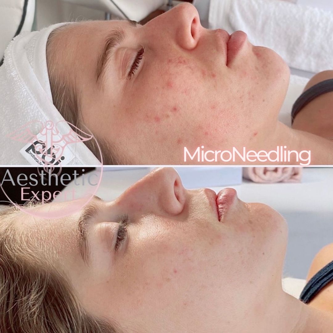 microneedling-nice