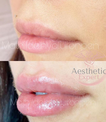 photo-avant-apres-aesthetic-expert-hyaluronpen-levres-extra