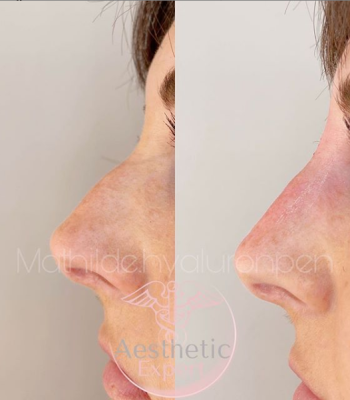 photo-avant-apres-aesthetic-expert-hyaluronpen-nez
